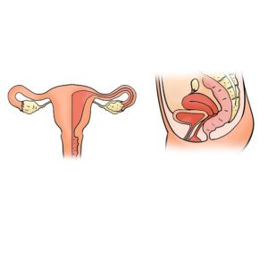 Polipy macicy – szyjkowe i endometrialne – jakie są objawy i metody leczenia ?